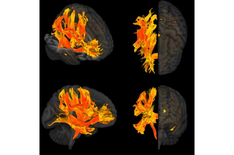 World first: Researchers identify specific regions of the brain that are damaged by high blood pressure and are involved in a de