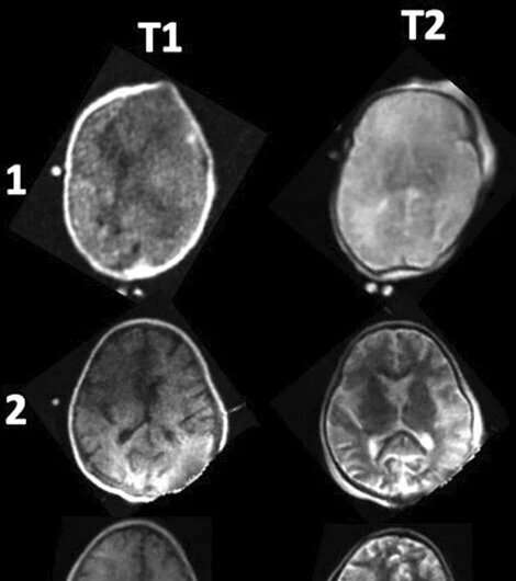 اولین مطالعات جهان با MRI قابل حمل کنار تخت در بیماران ECMO کودکان