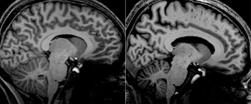 World's strongest MRI investigates COVID and myalgic encephalomyelitis/chronic fatigue impacts on the brain