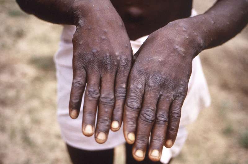 A new form of mpox that may spread more easily found in Congo's biggest outbreak