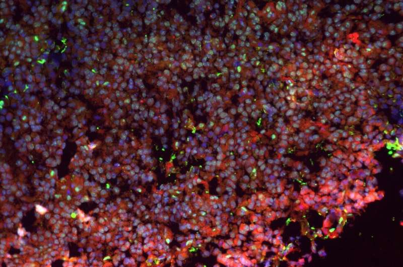 A study led by UPF describes how insulinomas, a rare type of pancreatic beta cell tumor, form