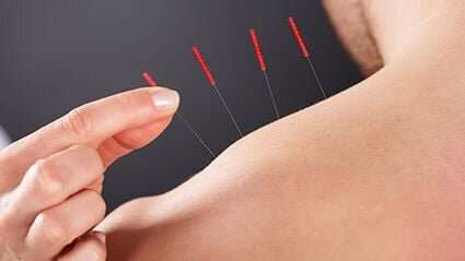 Acupuncture helps alleviate PTSD symptoms in combat veterans