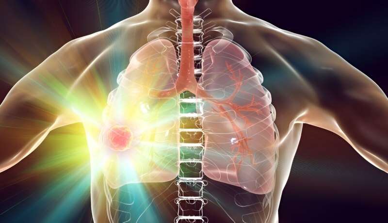 Alectinibe adjuvante melhora a sobrevida livre de doença no câncer de pulmão
