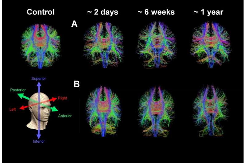 Advanced MRI scans help identify one in three concussion patients with 'hidden disease'