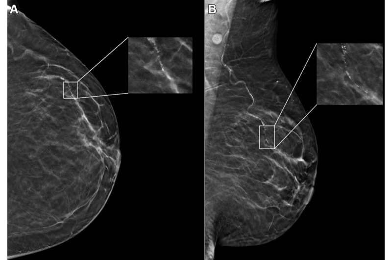 Age, race impact AI performance on digital mammograms