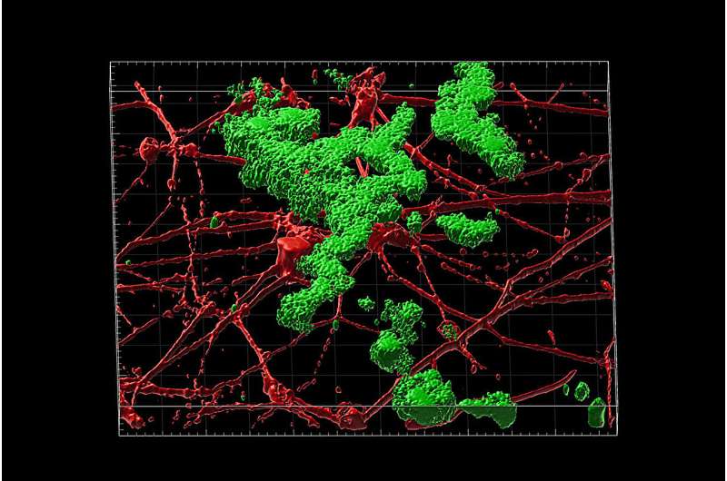 Aging-related genomic culprit found in Alzheimer's disease