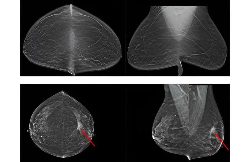 AI-assisted breast-cancer screening may reduce unnecessary testing