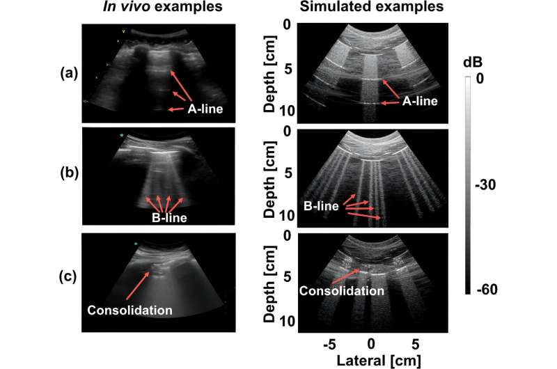 AI can now detect COVID-19 in lung ultrasound images