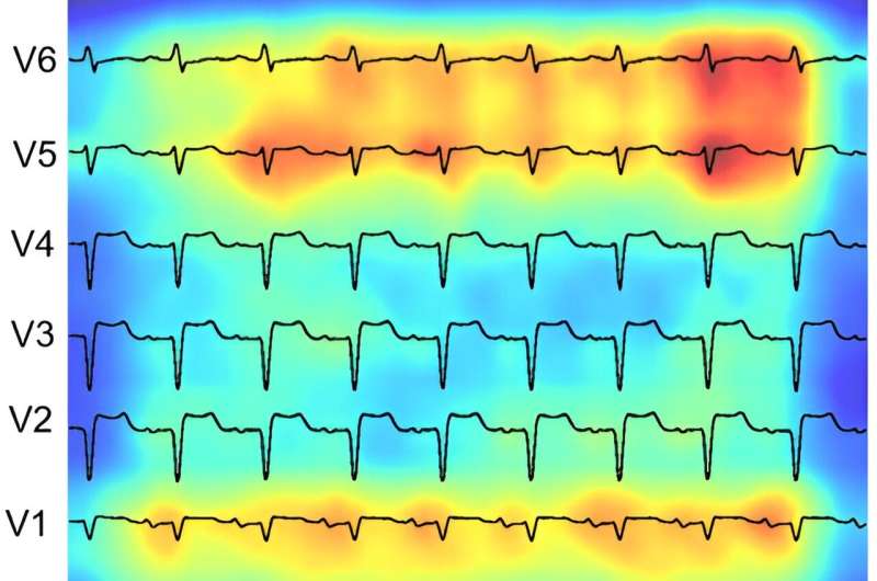 AI-driven study redefines right heart health assessment with novel predictive model
