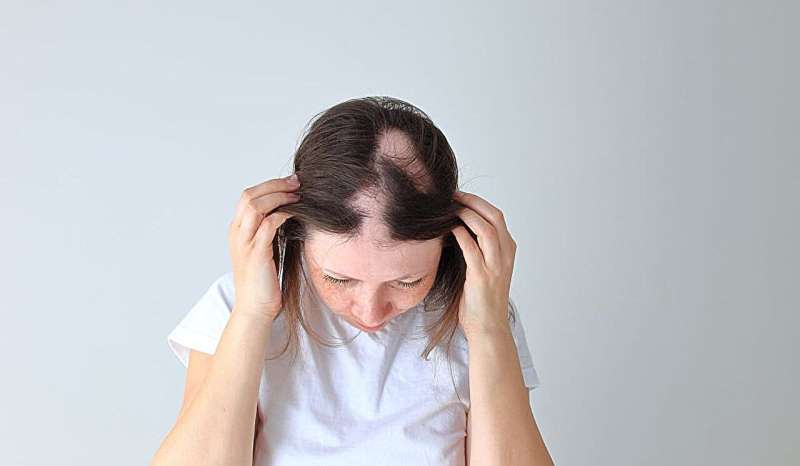 Alopecia tied to higher prevalence of autoimmune, psychiatric comorbidities