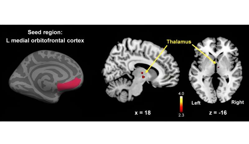 Altered brain morphology and functional connectivity in postmenopausal women