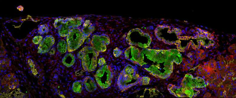 An Antibacterial protein, a new therapeutic target against pancreatic cancer