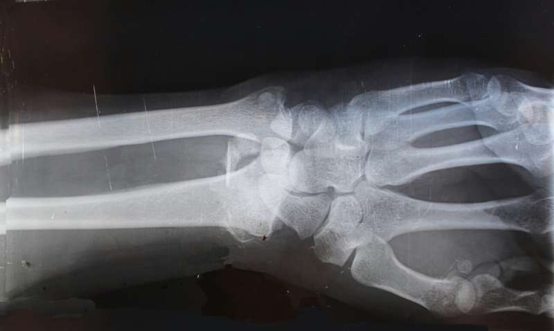 arm xray