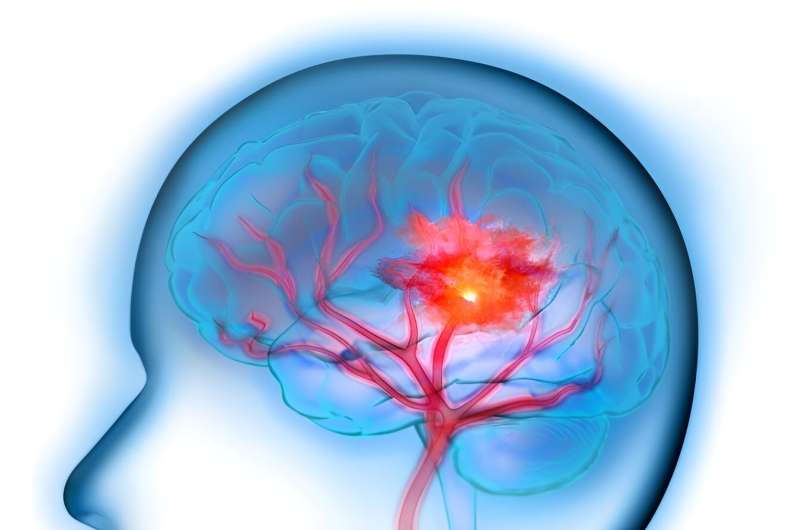 ASA: endovascular thrombectomy beneficial for large ischemic stroke