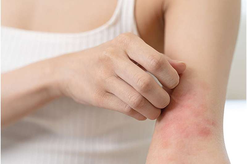 Atopic dermatitis has large impact on sexual function among women