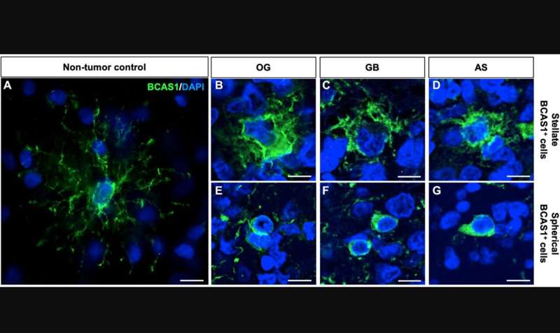 BCAS1 defines a heterogeneous cell population in diffuse glioma patients