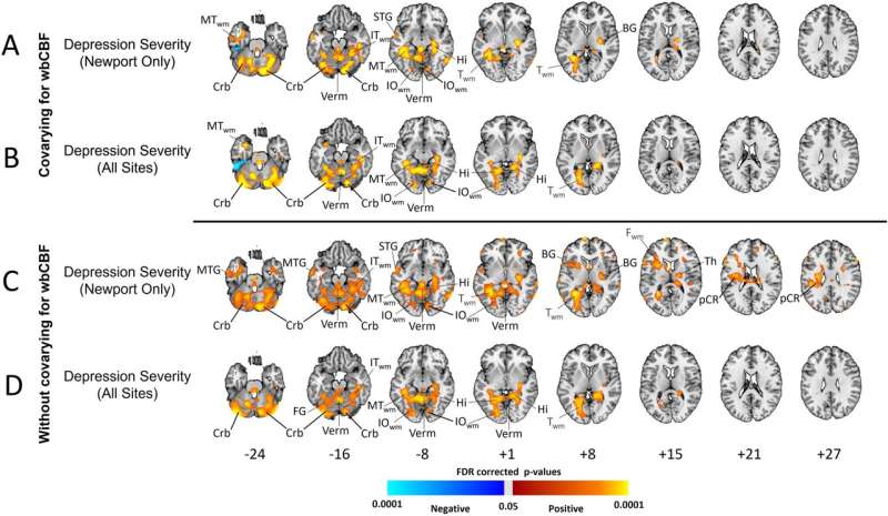Behavioral health researchers study hundreds of brain scans to explore the biology of depression