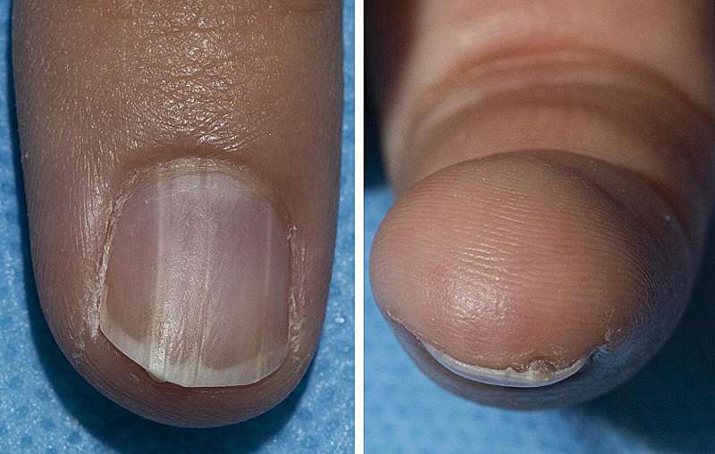 Benign nail condition linked to rare syndrome that greatly increases cancer risk