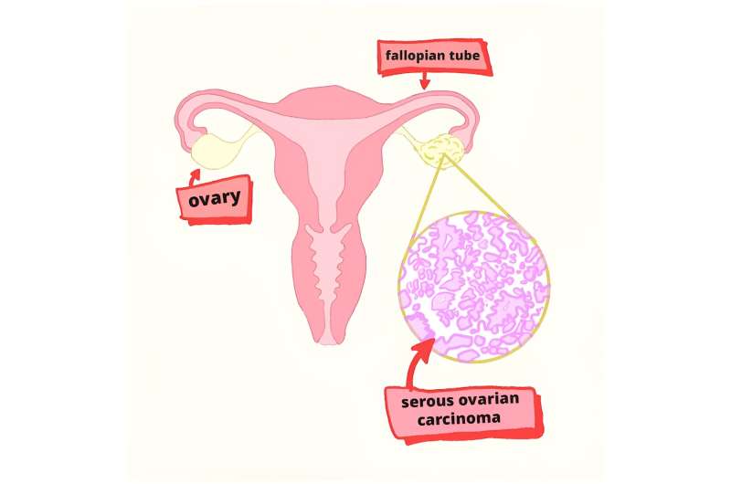 'Big data' analysis reveals new targets for treating ovarian cancer