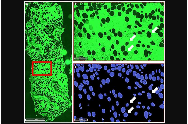 Bone marrow adipocytes provide early sign of progression from MGUS to multiple myeloma