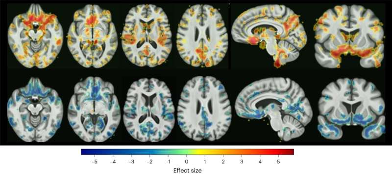 Brain structure predicts treatment response to antidepressant and placebo medications