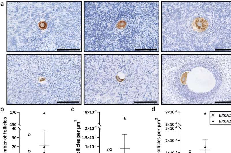 BRCA1 gene mutation may increase the risk of impaired fertility, study shows