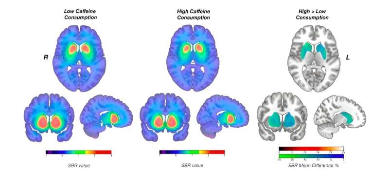 Caffeine affects brain dopamine function in patients with Parkinson's disease