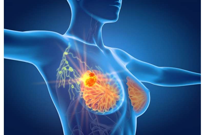 Clinical breast exam rarely detects second breast cancer after DCIS