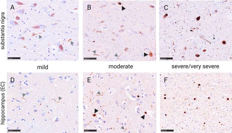 Common degenerative brain disease may begin to develop already in middle age