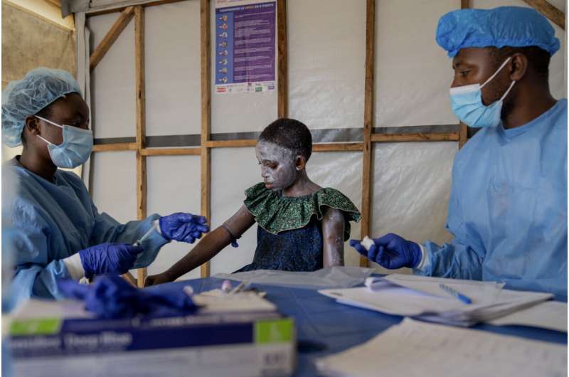 La crisis humanitaria del Congo contribuyó a que el mpox volviera a caer en una emergencia sanitaria mundial