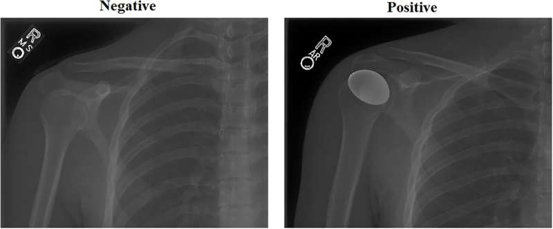 Deep learning enables faster, more accurate decisions for treatment of shoulder abnormalities 