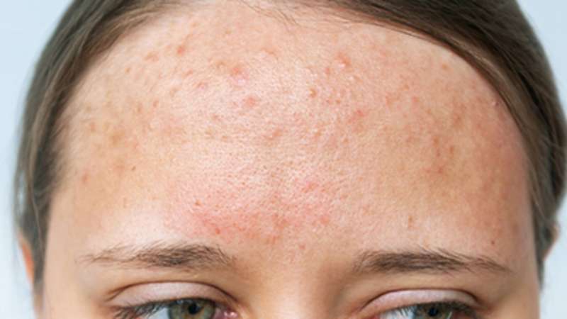 Dermatologists' group offers latest guidance on acne