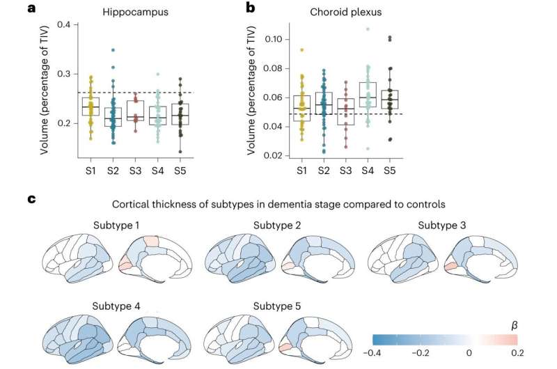 Diferenças no líquido cefalorraquidiano de pacientes com Alzheimer sugerem possibilidade de variantes