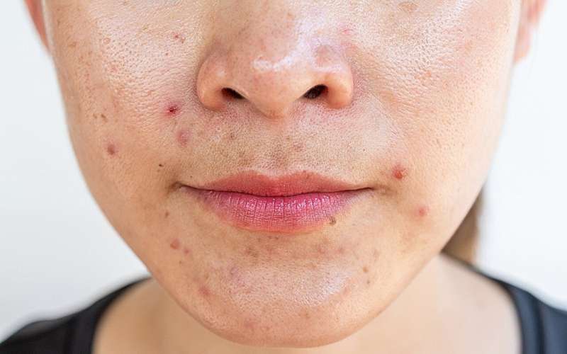 Direct CGRP inhibition cuts acne, rosacea in patients with migraine