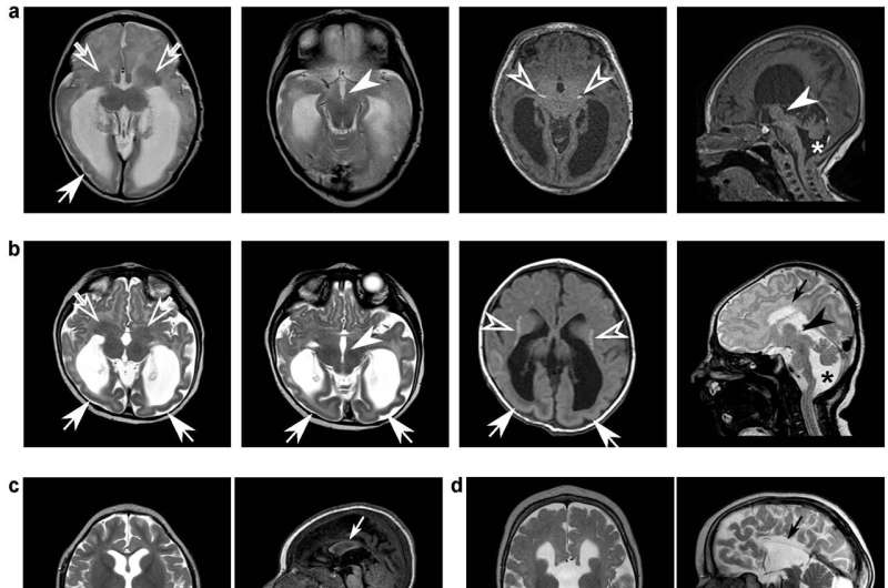 La scoperta fornisce risposte ai genitori di bambini con malattie rare