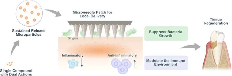 Dissolvable microneedle patch enables local delivery of immunomodulatory microparticles containing bifunctional molecules for periodontal tissue regeneration