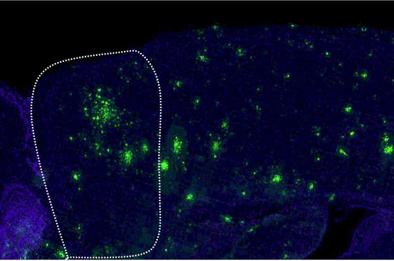 Dopamine treatment alleviates symptoms in Alzheimer's disease