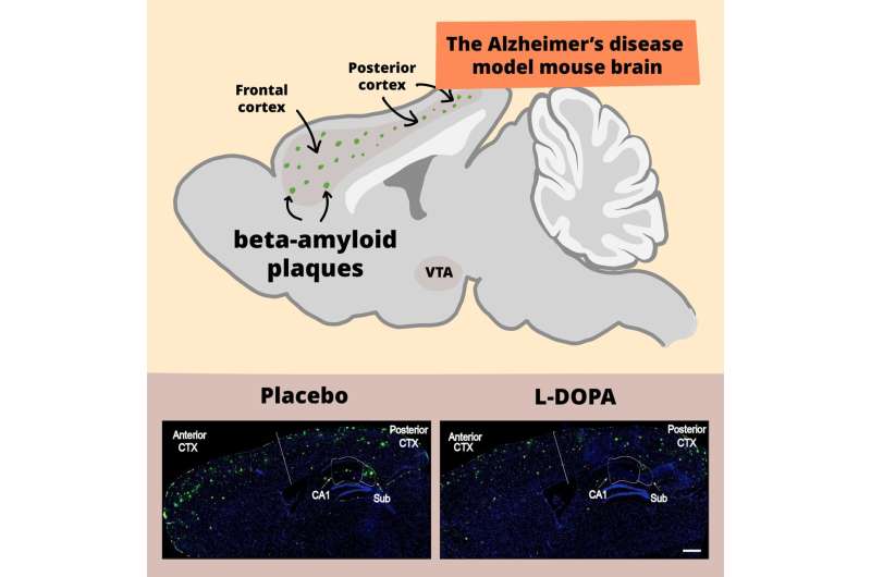 Dopamine treatment alleviates symptoms in Alzheimer's disease