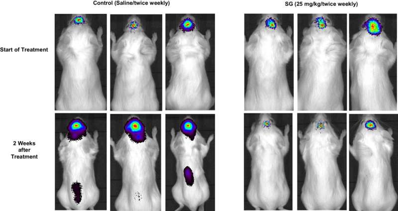 Drug shows promise for treating brain tumors resulting from breast cancer, trial reports