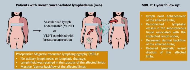 Effective lymph node transfer eases arm swelling in breast cancer patients