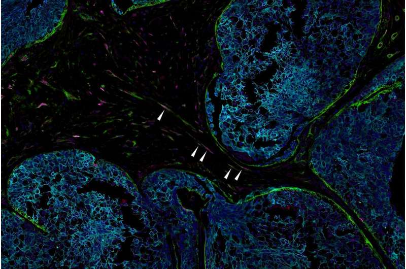 Eliminating senescent cells could help treat breast, pancreatic cancers