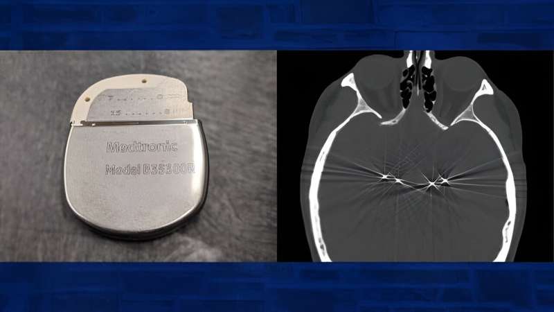 Engineering a more elegant deep brain stimulation therapy for Parkinson's