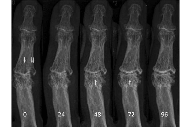 Erosion blockade breakthrough: Clinical trial signals hope for hand osteoarthritis