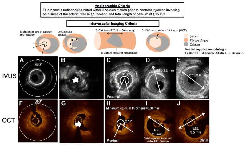 Expert consensus statement published on management of calcified coronary lesions requiring intervention