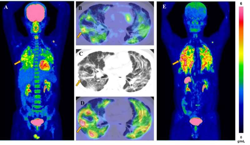 FAPI PET/CT bests FDG in predicting progressive lung disease