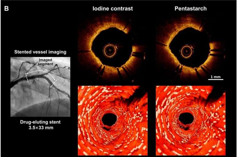 First-in-the-field application of non-contrast optical coherence tomography for coronary artery disease