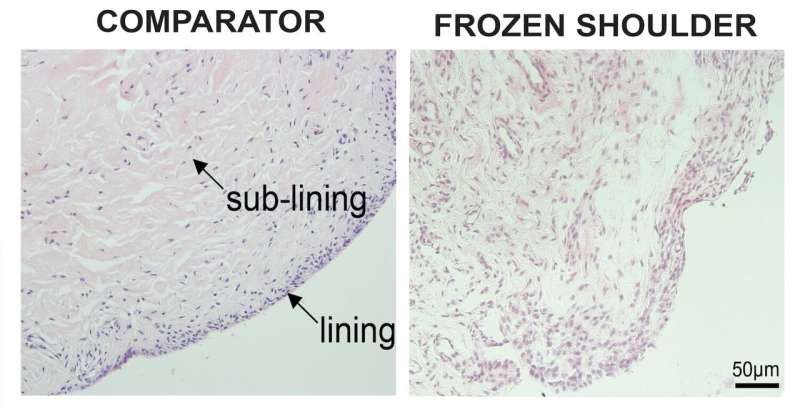 Frozen shoulder holds the key to understanding fibrosis resolution