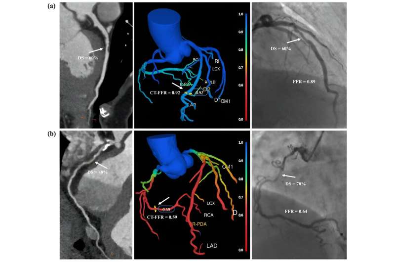 Fully-automated one-click on-site CT-FFR: a novel tool for functional evaluation for patients with coronary artery disease