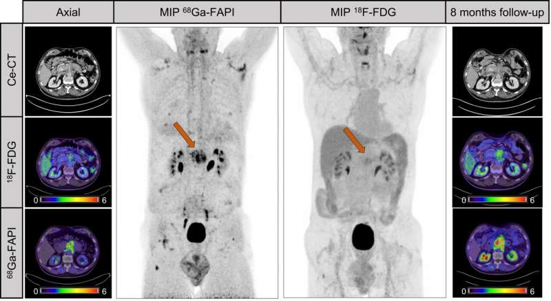 Ga-68 FAPI PET improves detection and staging of pancreatic cancer