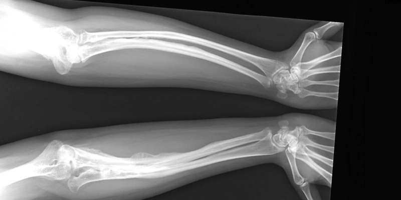 Gaining a better understanding of brittle bone disease – without animal experiments